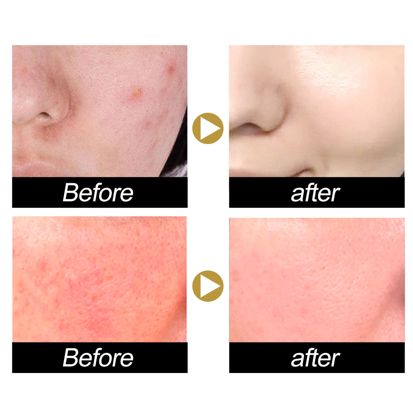 Snail Face Cream Anti Redness Pimple Removal Shrink Pores Repair Sensitive Skin Replenishing Moisturizer Acne Treatment Cream
